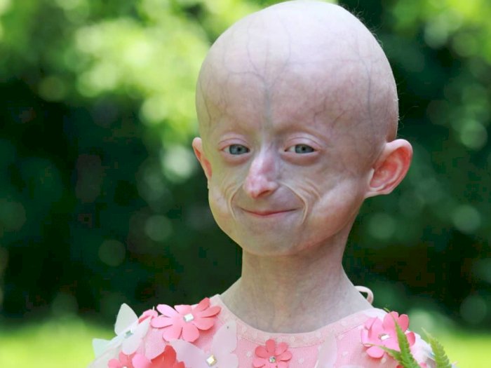 Gadis 10 Tahun yang Menderita Penuaan Dini progeria Meninggal Dunia