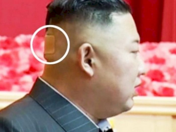 Kim Jong Un Bikin Rakyatnya Khawatir Gegara Pakai Plaster di Belakang Kepala