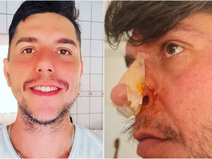 Operasi Bibir Gagal, Pria Ini Jadi Punya Tiga Lubang Hidung