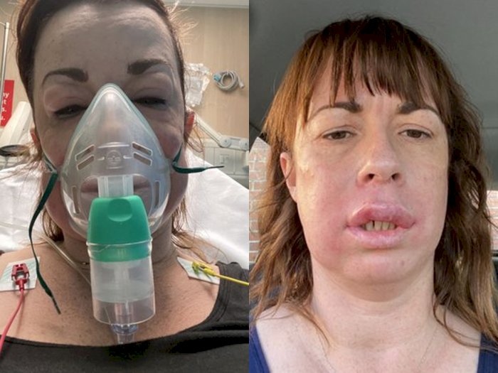 Nyawa Wanita Ini Hampir Melayang Setelah Wajahnya Disuntik Filler dan Botox