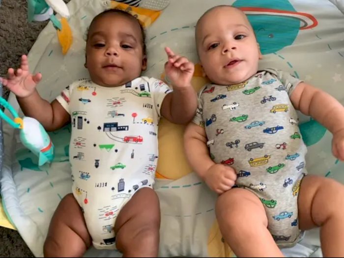 Lahirkan Bayi Kembar dengan Warna Kulit Berbeda, Ibu Ini Sempat Terkejut