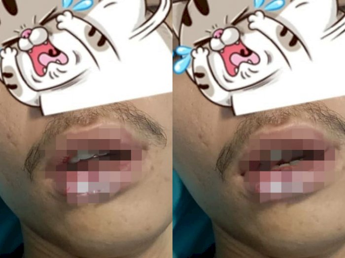 Terlibat Cekcok, Bibir Pemuda Ini Koyak karena Digigit Pengendara Motor