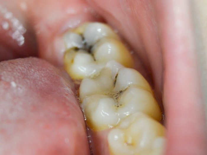 7 Penyebab Gigi Berlubang yang Harus Diwaspadai