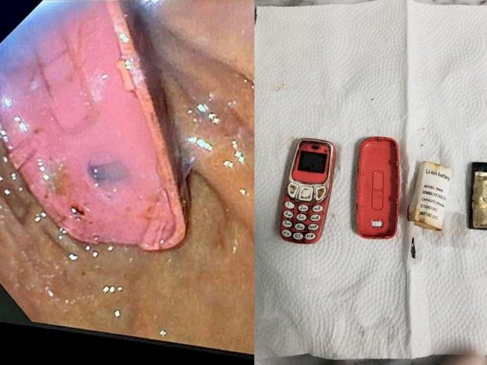 Pria Ini Sengaja Menelan Handphone Nokia Model Lama, Dokter: Untung Tak Meledak