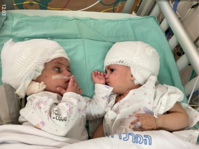 Setelah Menjalankan 12 Jam Operasi, Bayi Kembar Siam Ini Berhasil Dipisahkan