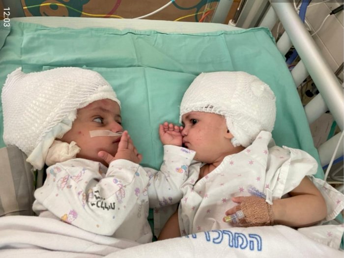 Setelah Menjalankan 12 Jam Operasi, Bayi Kembar Siam Ini Berhasil Dipisahkan