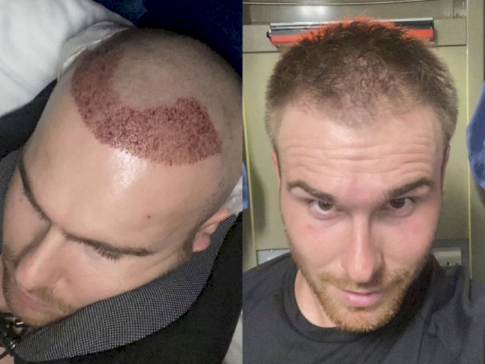 Jalani Transplantasi Rambut karena Botak, Pria Ini Akui Kepercayaan Dirinya Meledak