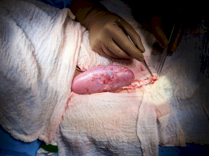 Transplantasi Ginjal Babi ke Manusia Sukses, Pakar: Wajar, Karena Secara Genetik Mirip