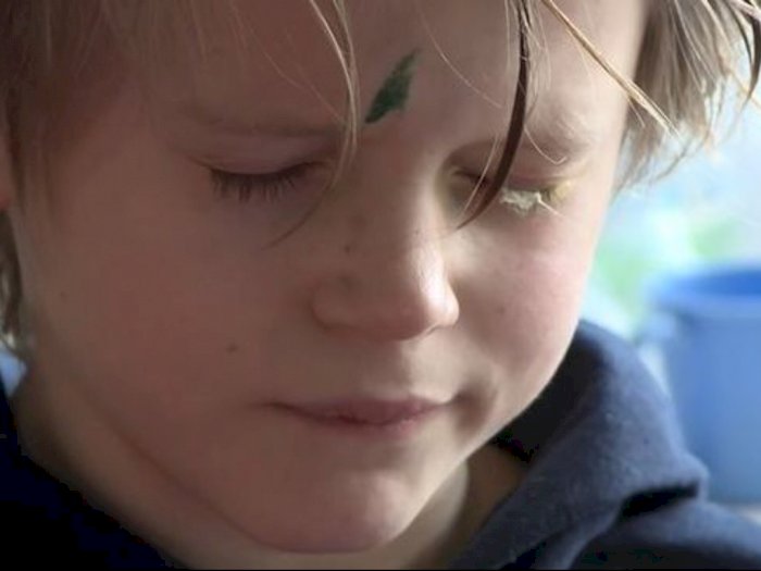 Mata Bocah Ini Tak Mau Terbuka Selama 4 Hari Setelah Bapaknya Meneteskan Lem ke Matanya