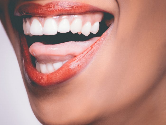 Mengenal Wisdom Teeth Impaction, Saat Gigi Tumbuh Tidak Sesuai