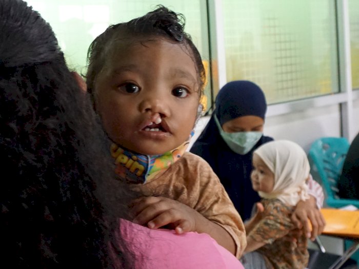 Operasi Bibir Sumbing Gratis di Papua, Berikut Foto-fotonya