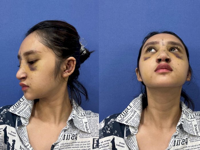 Hasil Operasi Plastik Dhyaz Anak Farida Nurhan, Netizen Soroti Bentuk Hidungnya
