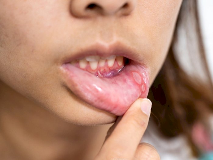 Jangan Abai! 4 Masalah Gigi dan Mulut Ini Muncul Akibat Stres dan Cemas Berlebihan