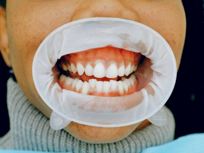Cara Jaga Kebersihan Gigi dan Mulut Selama Puasa agar Tak Terjadi Penumpukan Plak