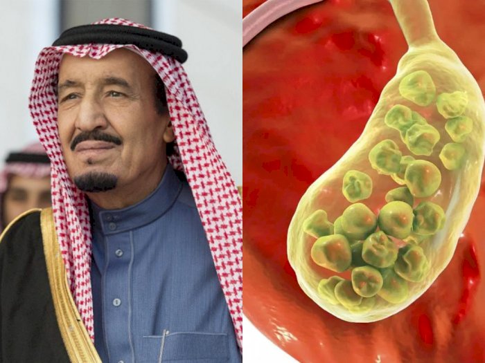 Mengenal Radang Kantong Empedu, Kondisi Kesehatan yang Dialami Raja Salman sampai Masuk RS