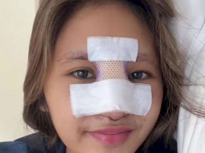 Putri Farida Nurhan Malah Infeksi Parah Usai Implan Hidung: Sakit!