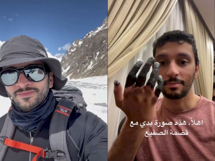 Hobi Mendaki Gunung, Pria Arab ini Alami 'Frostbite', Jari Tangan Terpaksa Diamputasi