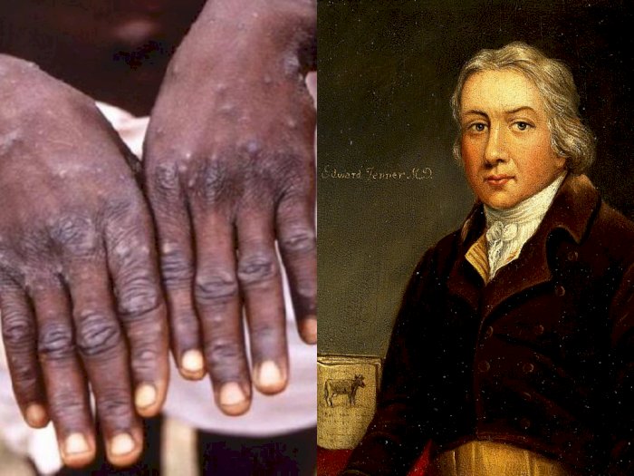 Sosok Dokter Edward Jenner, Penemu Vaksin Cacar Pertama di Dunia, Selamatkan Jutaan Nyawa