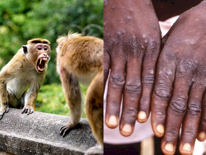 Kabar Baik! WHO Yakin Cacar Monyet Bisa Dikendalikan: Tak Ada Bukti Virusnya Bermutasi
