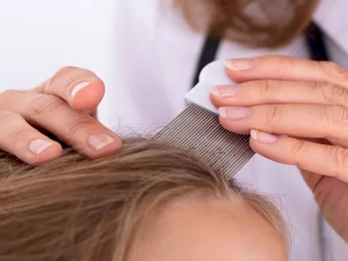 5 Cara Menghilangkan Kutu Rambut dan Telurnya, Gatal Dijamin Hilang! 