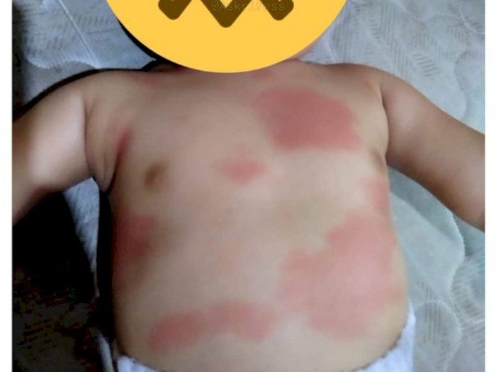 Tubuh Bayi Ini Merah-Merah usai Sang Ibu Beri Obat Resep dari TikTok, Netizen Geram