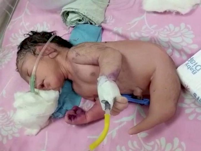 Langka! Bayi di India Lahir dengan Kondisi Kaki seperti Ekor