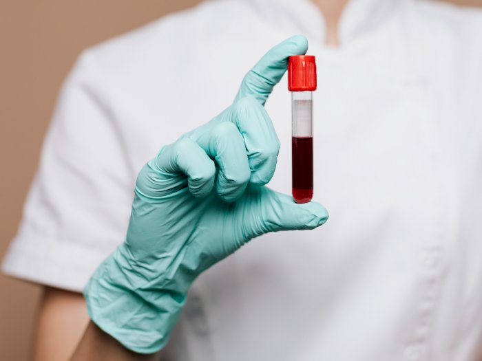 Ilmuwan Temukan Pemilik Golongan Darah A Berisiko Tinggi Kena Stroke