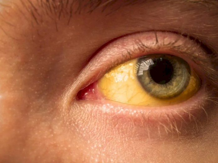 Mengenal Penyakit Kuning, Salah Satu Gejala Hepatitis 