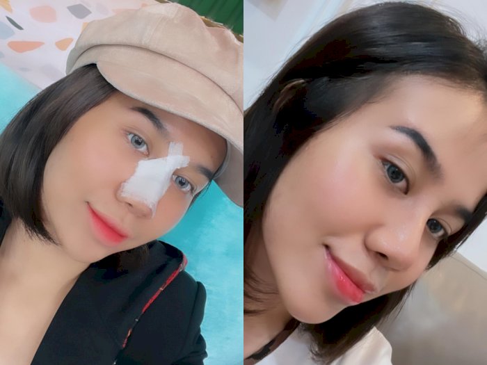 Mayang Pamer Hasil Operasi Hidung Rp50 Juta: Aura Artisnya Belum Dapet