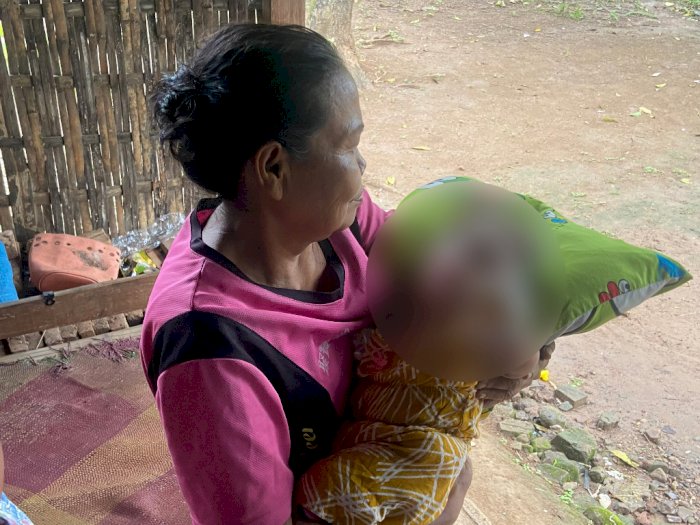 Tolong! Kisah Pilu Bayi Tanpa Tempurung Kepala di Ponorogo, Butuh Biaya Operasi 