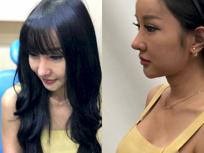 Lucinta Luna Lepas Perban, Pamer Hidung Baru Usai Oplas di Thailand: Batangnya Kegedean