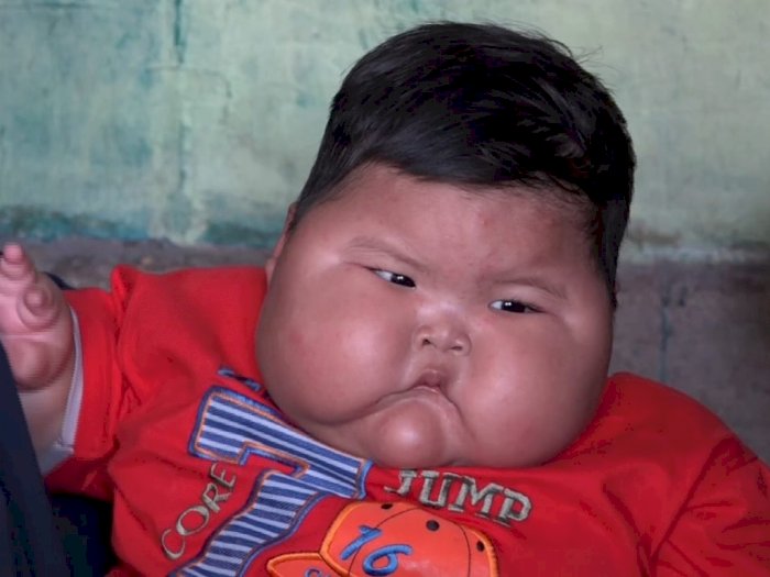 Balita Obesitas di Bekasi akan Dirawat di Rumah Sakit, Ditanggung BPJS!