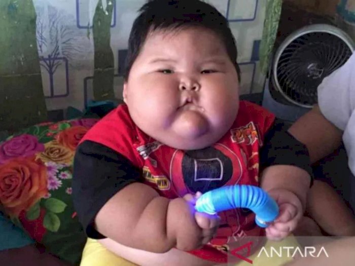 Khawatir Ada Penyakit Lain, Balita Obesitas di Bekasi Dirujuk ke RSCM Jakarta