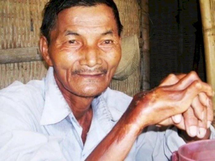 Cerita Unik Thai Ngoc, Pria Vietnam yang Gak Bisa Tidur Selama 50 Tahun!