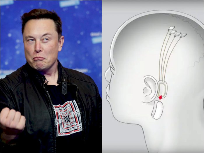 Perusahaan Elon Musk Dapat Izin Tanam Chip di Otak Manusia: Lololo Gak Bahaya Ta?