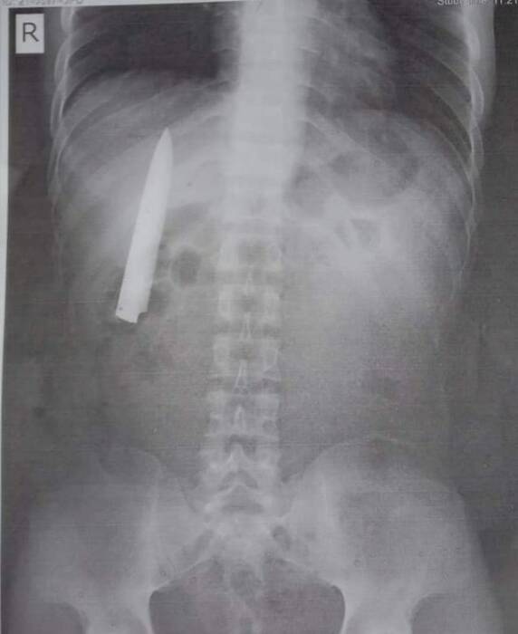 X-Ray. (Photo/World of buzz) ditusuk