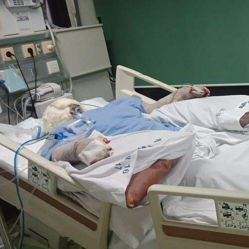 Indah Daniarti (22) saat menjalani perawat di RSUD Hasan Sadikin akibat luka bakar yang diderita. (Kitabisa) Indah Daniarti (22) saat menjalani perawat di RSUD Hasan Sadikin akibat luka bakar yang diderita. (Kitabisa)