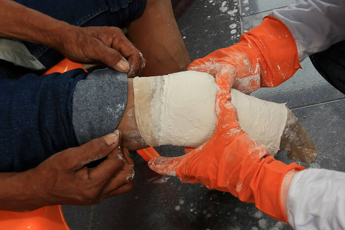 ANTARA FOTO/Syifa Yulinnas PENGUKURAN KAKI PALSU UNTUK PENYANDANG DISABILITAS