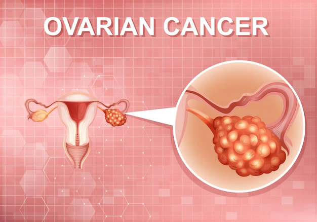 Ilustrasi kanker ovarium (Freepik/brgfx)