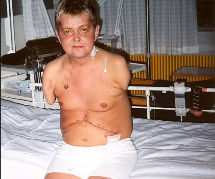 Felix usai menjalani operasi amputasi tangan di tahun 1998. (Foto/Felix Gretarsson/SWNS)