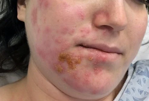 Justin Bieber idap Ramsay Hunt Syndrome