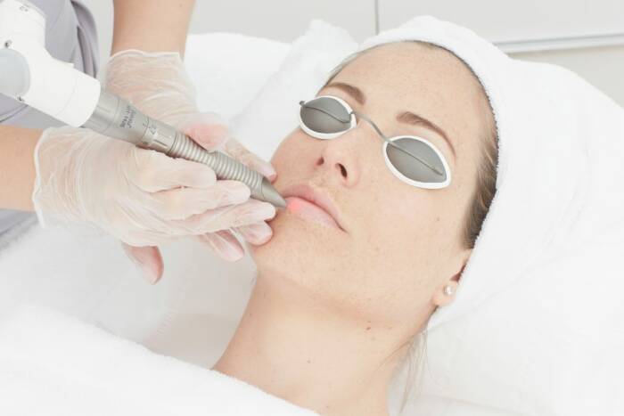 Laser Lip Rejuvenation