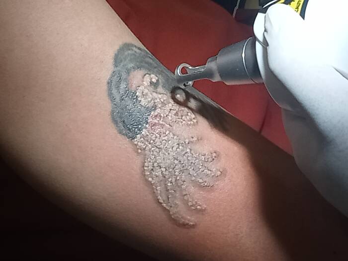 Proses penghapusan tato di RS Bhayangkara Tulungagung (Z Creators/Firman Imansyah)